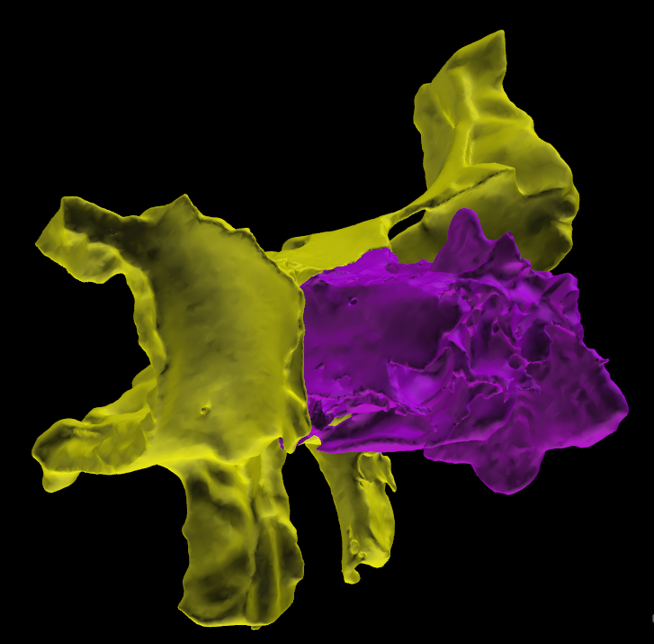 Sfenoide Etmoide 3D Anatomia