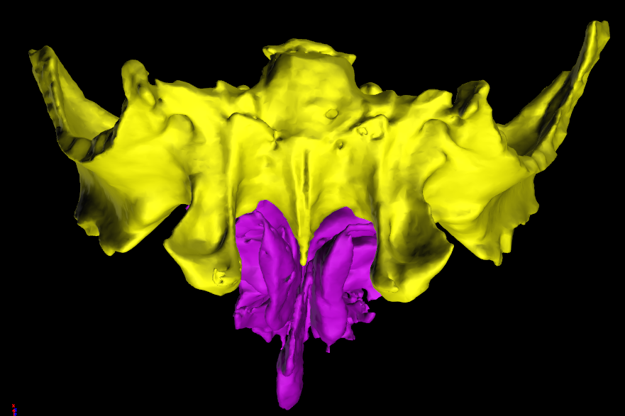 Sfenoide Etmoide 3D Anatomia